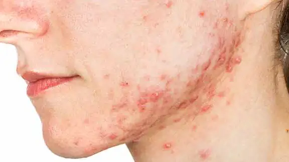 cysts from acne