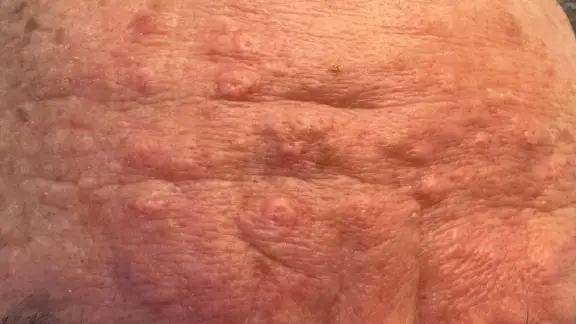 nodules from acne