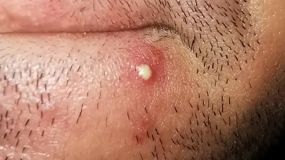 pustule from acne